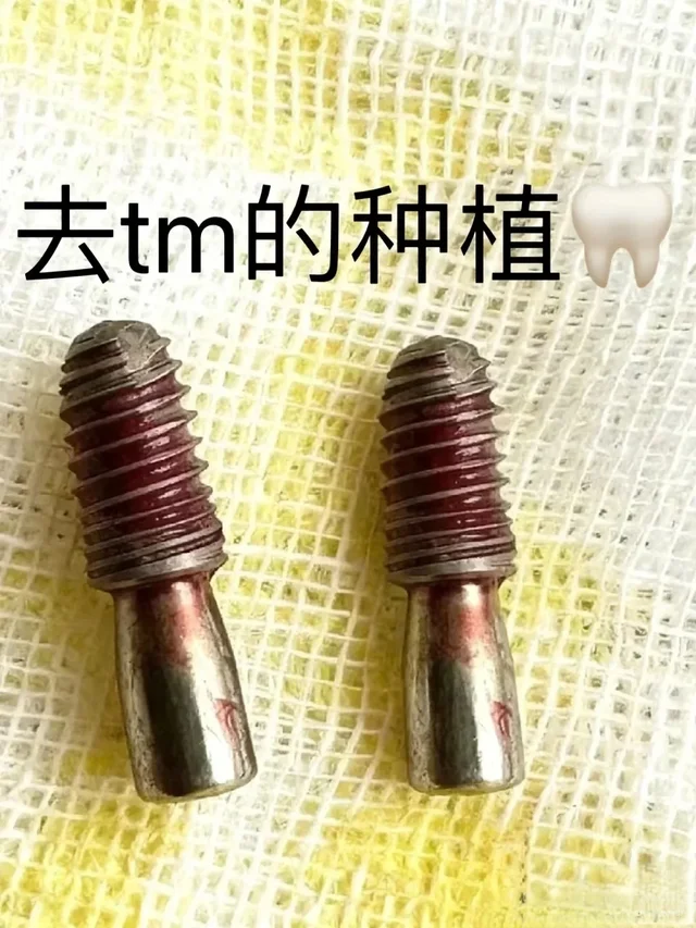 希望12月做种植牙的都能刷到我这篇文章