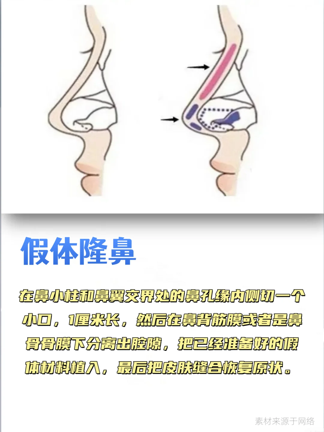 鼻综合包含哪些项目？这组图文带你搞清楚！