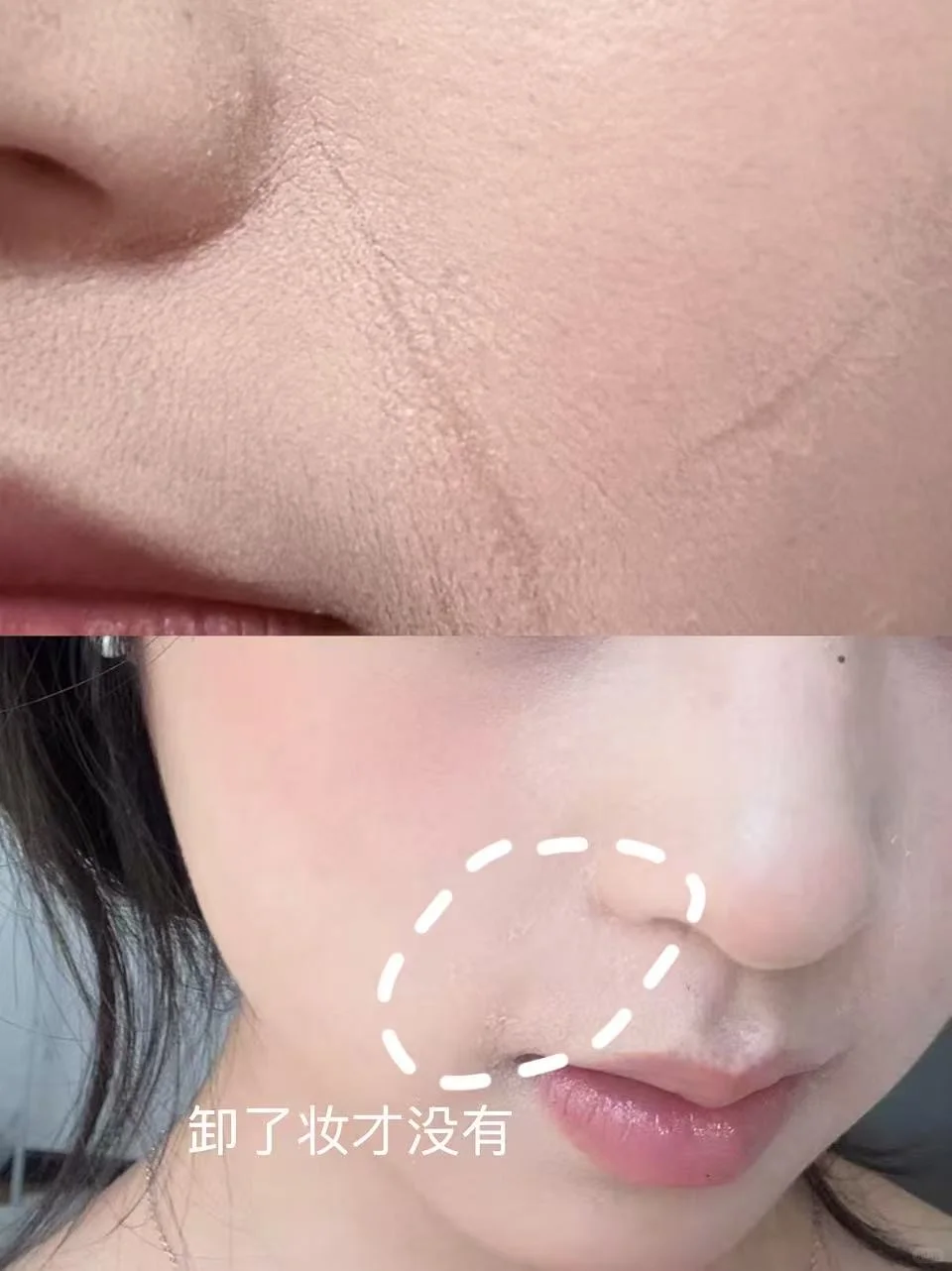 只能卸掉的法令纹和唇周的积线终于没了……