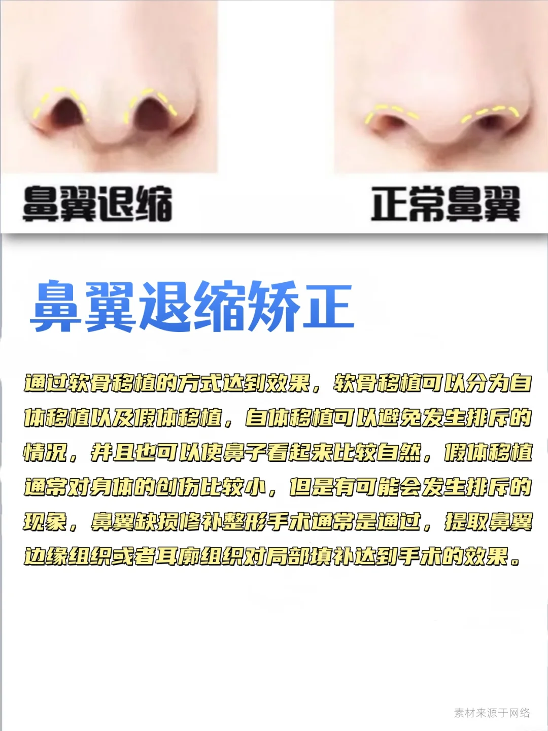 鼻综合包含哪些项目？这组图文带你搞清楚！