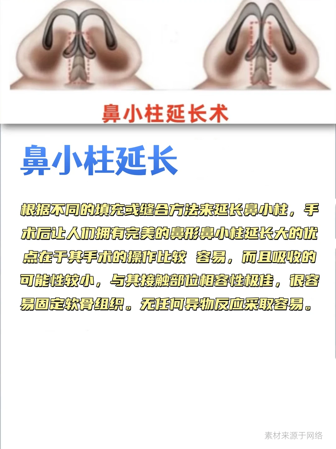 鼻综合包含哪些项目？这组图文带你搞清楚！