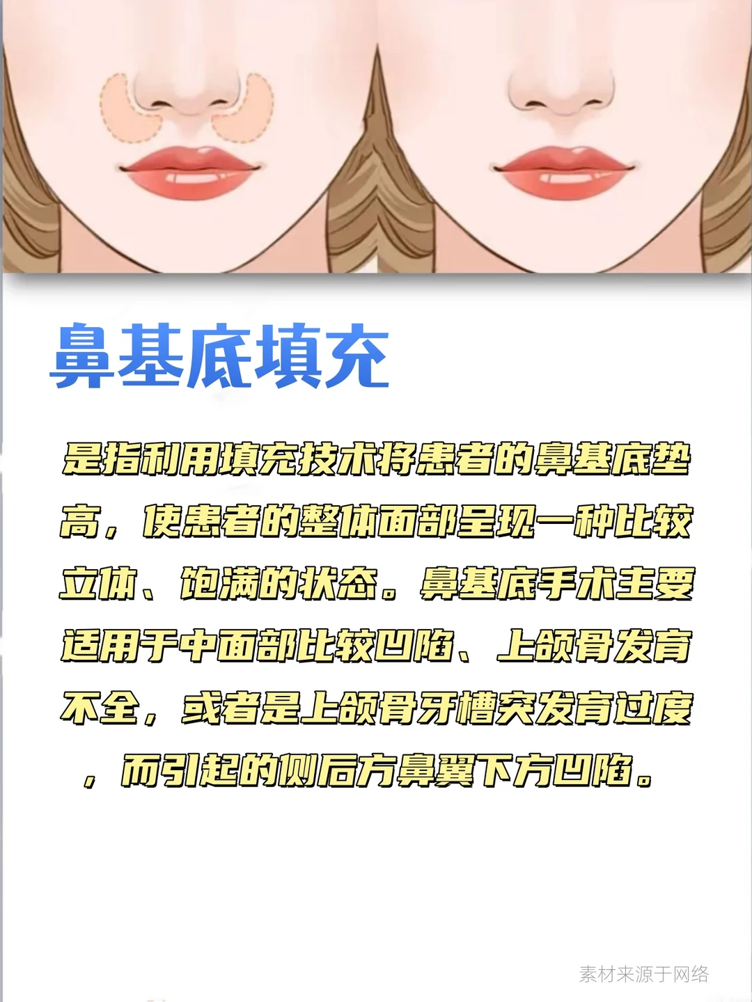 鼻综合包含哪些项目？这组图文带你搞清楚！