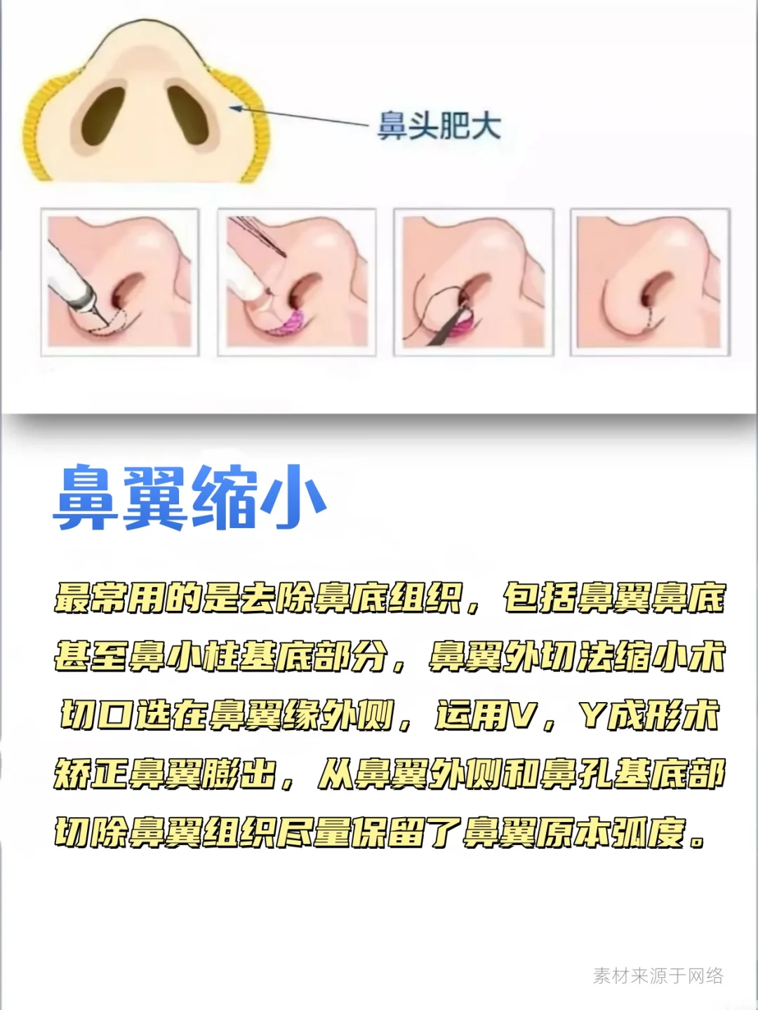 鼻综合包含哪些项目？这组图文带你搞清楚！