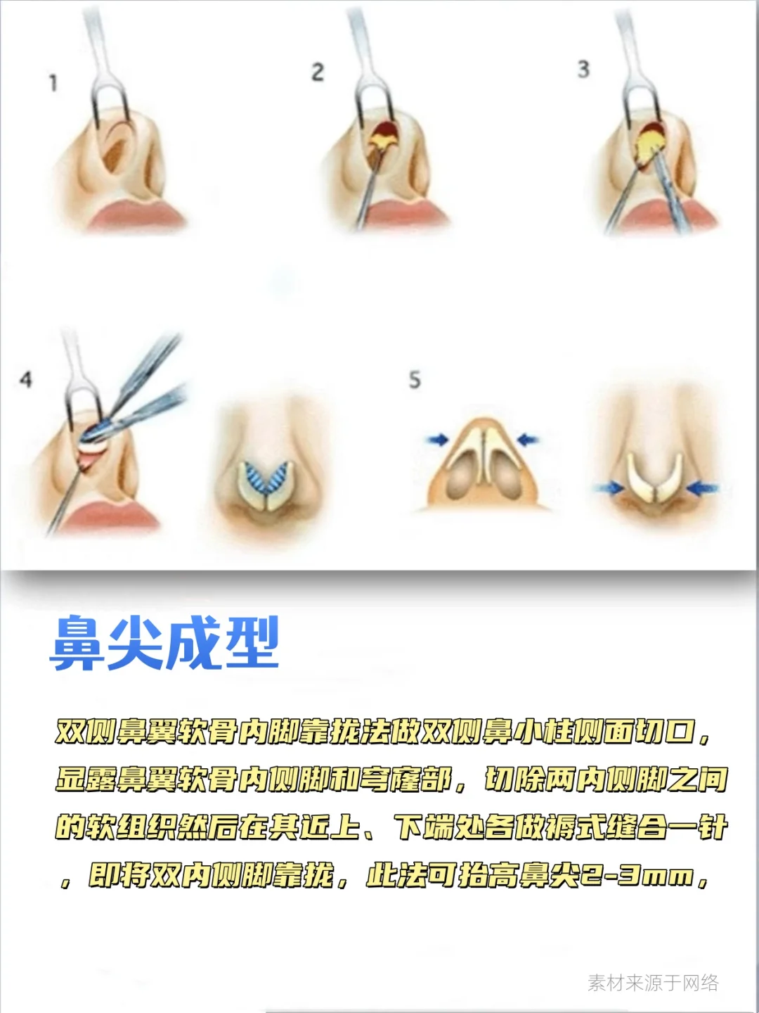鼻综合包含哪些项目？这组图文带你搞清楚！