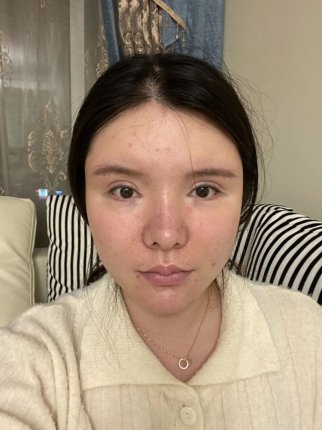 脂肪填充3次 把自己填成了一个球 上岸成功