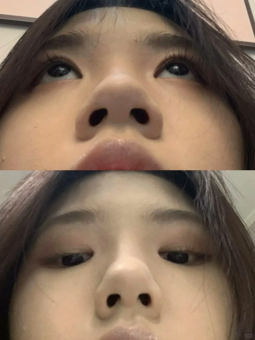 谁懂缩完鼻翼的救赎感！