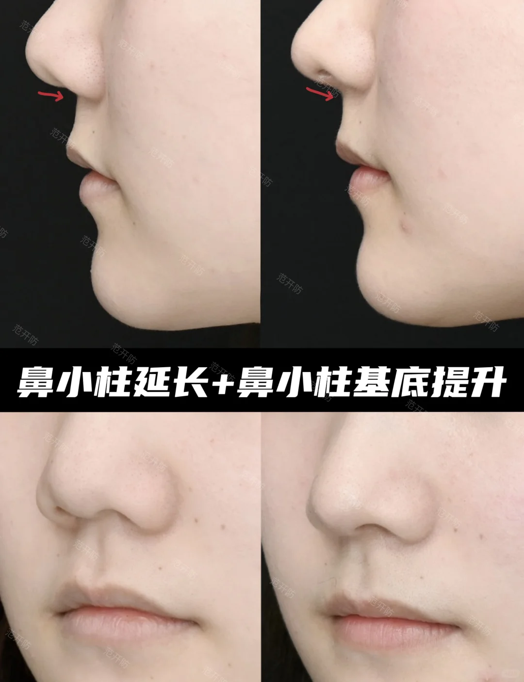 ✨鼻小柱萎缩内陷调整