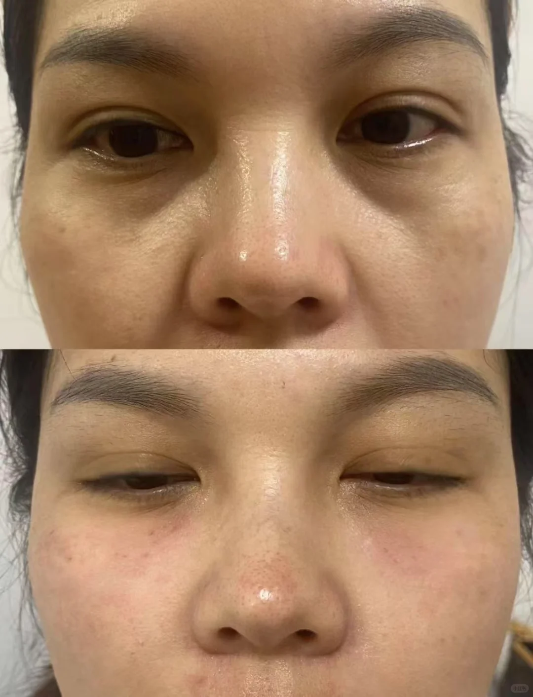 泪沟法令纹面颊填充