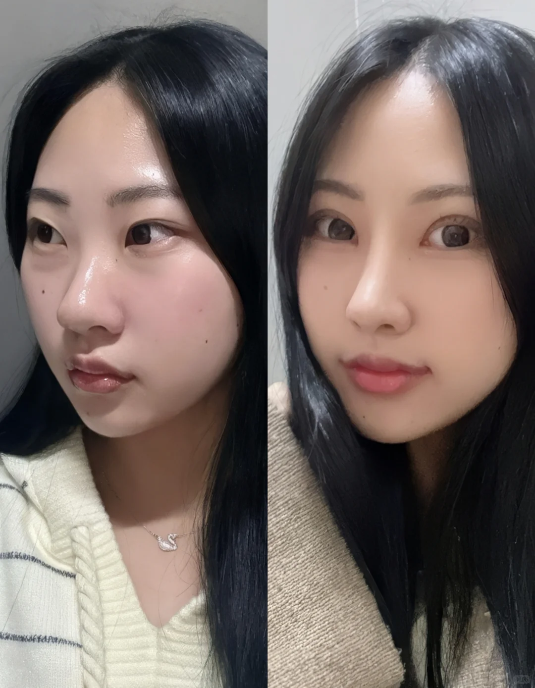 3W爆改的蒜头鼻，来评价一下，不玻璃心