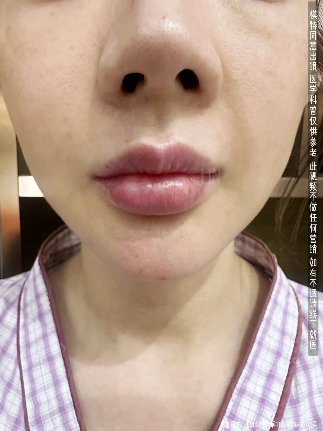 嘴角上扬刚刚出来状态 真实反馈~