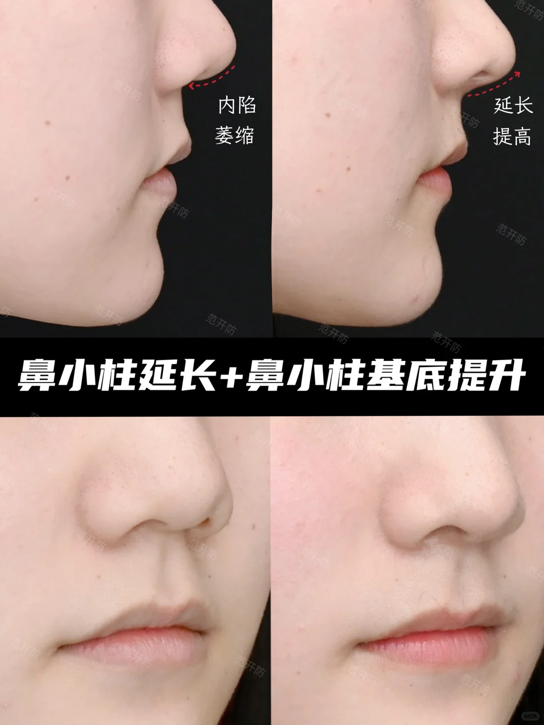 ✨鼻小柱萎缩内陷调整