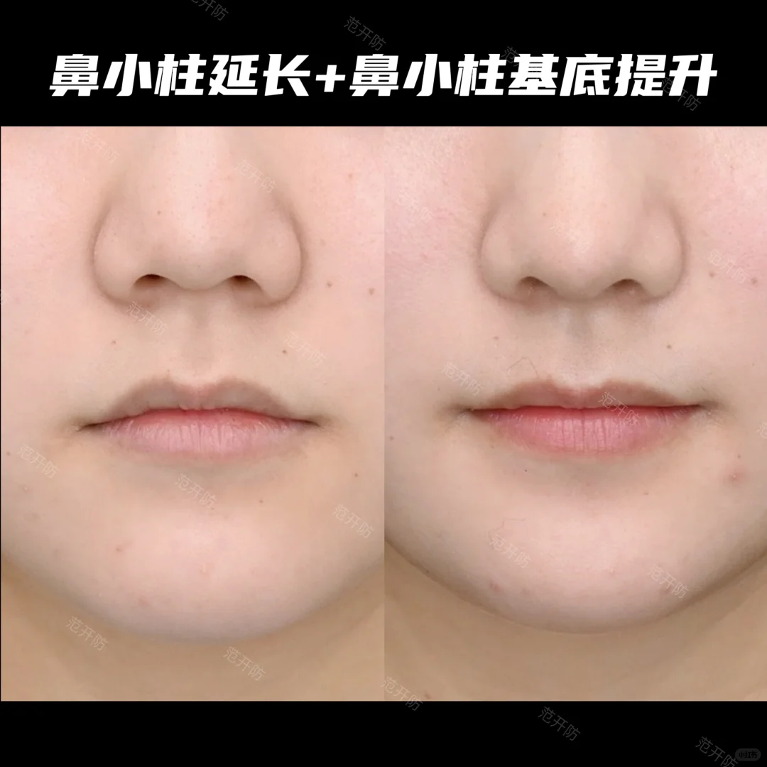 ✨鼻小柱萎缩内陷调整