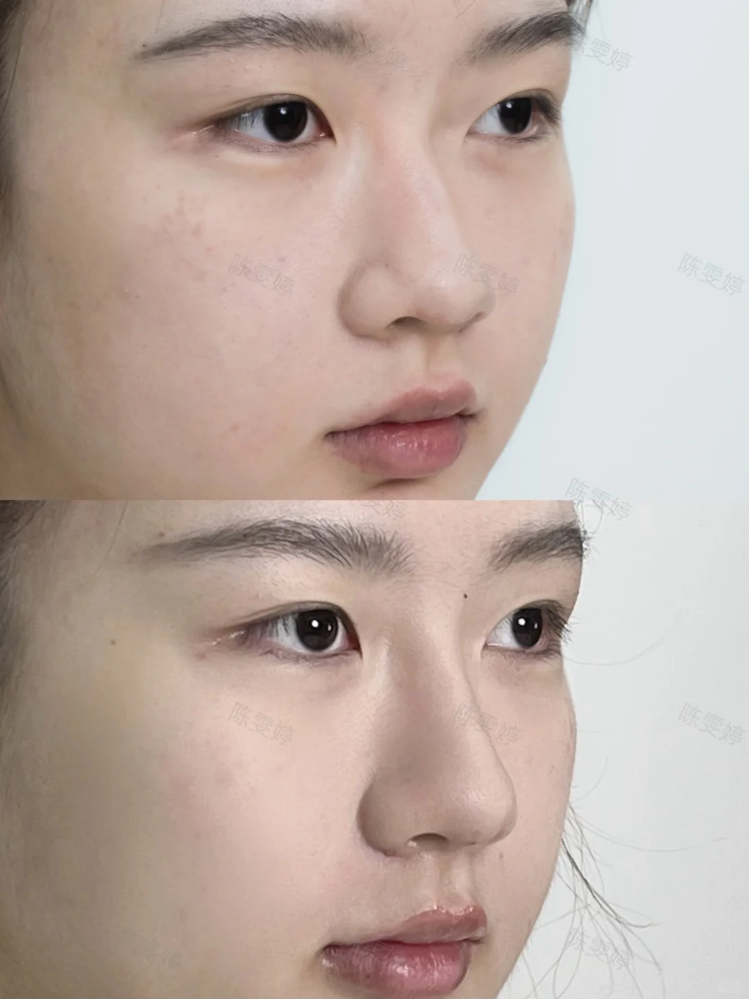 注射鼻即刻 这妈生感真的绝了