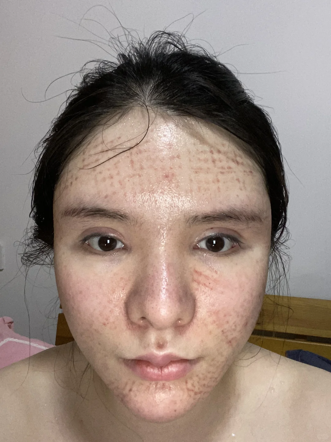 脂肪填充3次 把自己填成了一个球 上岸成功