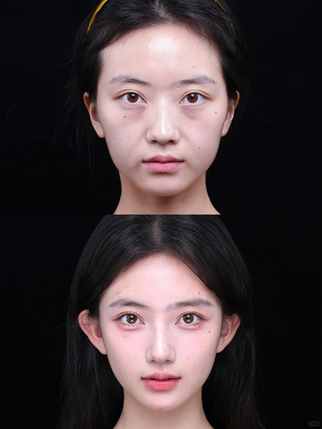 注射+轮廓，颜值已经到达下一个level