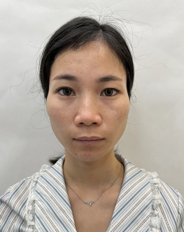 普通人打完啵啵三个月变化，算自救成功吗？