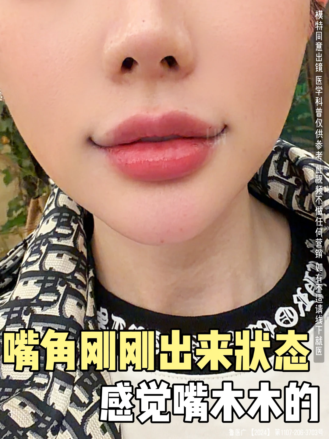 嘴角上扬刚刚出来状态 真实反馈~