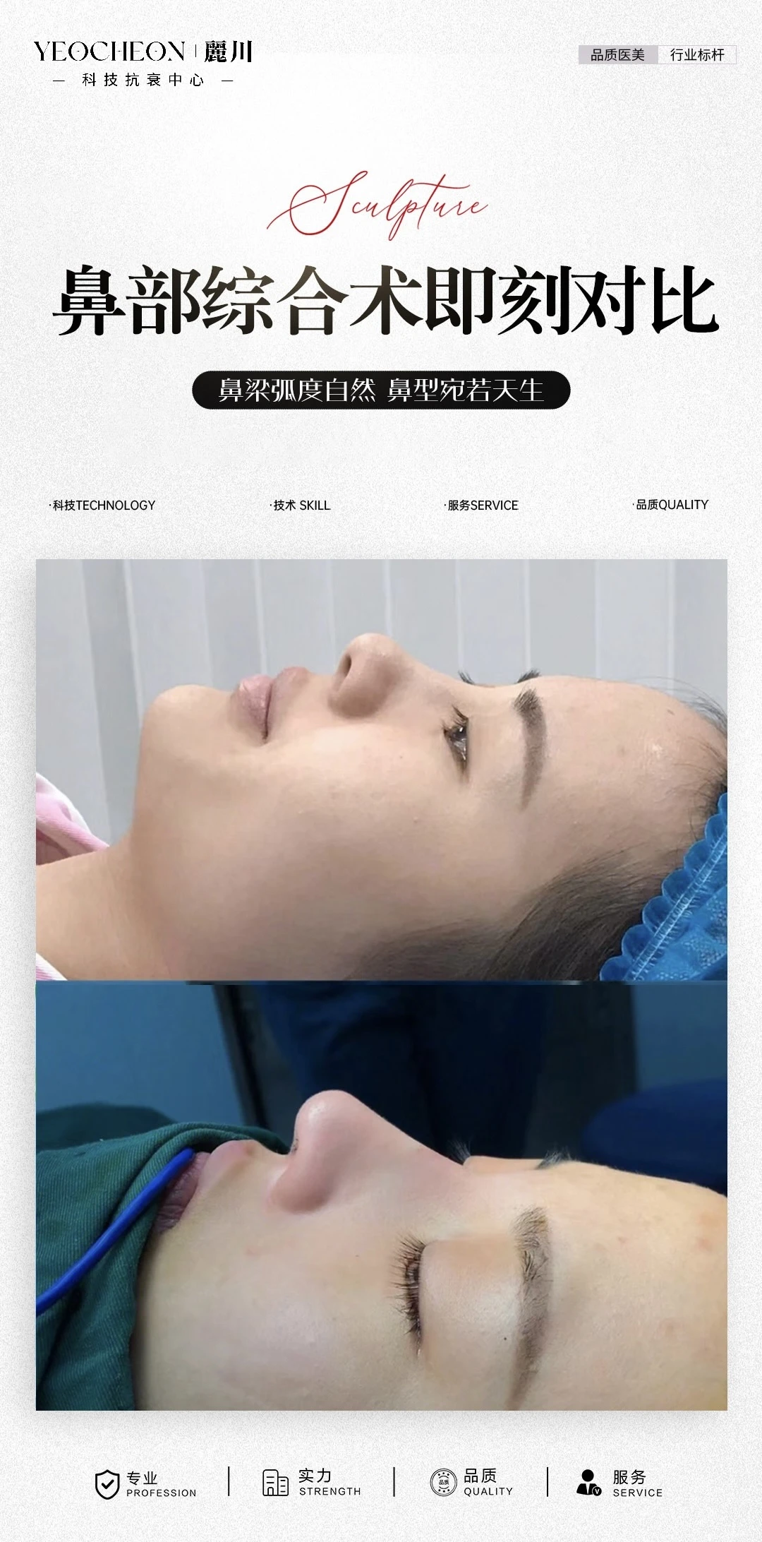 🏥鼻综合术后对比🆚