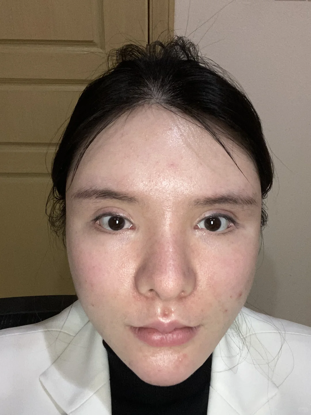 脂肪填充3次 把自己填成了一个球 上岸成功