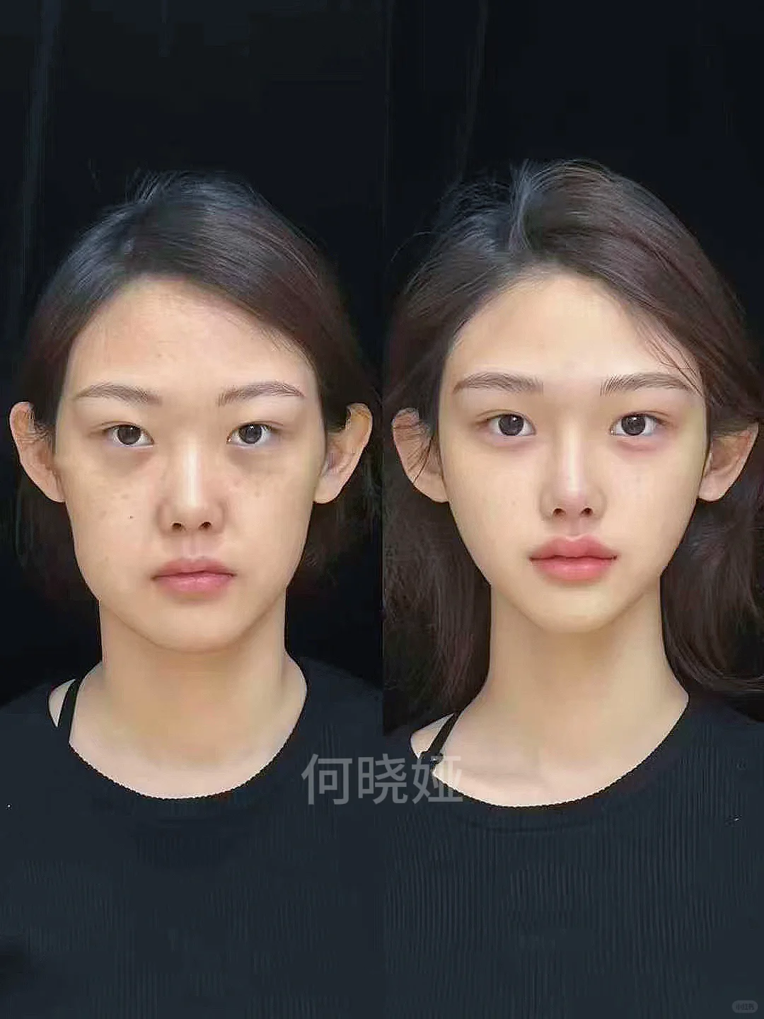 石家庄玻尿酸｜3k微调成素颜美女