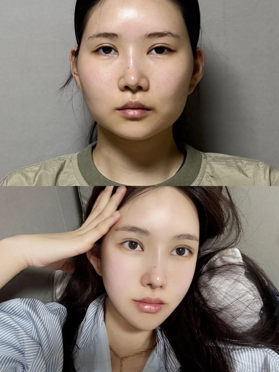 成都颧骨下颌角🍄一年记录