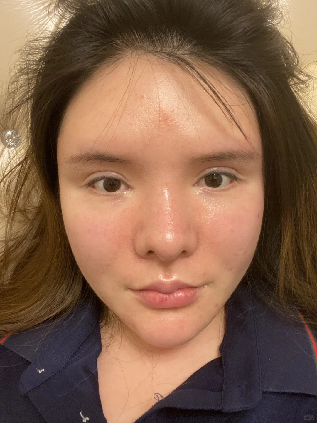 脂肪填充3次 把自己填成了一个球 上岸成功