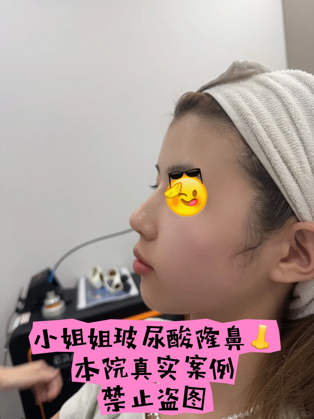 韩国皮肤科🇰🇷玻尿酸微调👃