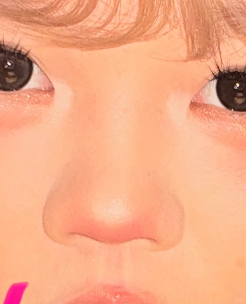 原生鼻很自卑建议do吗