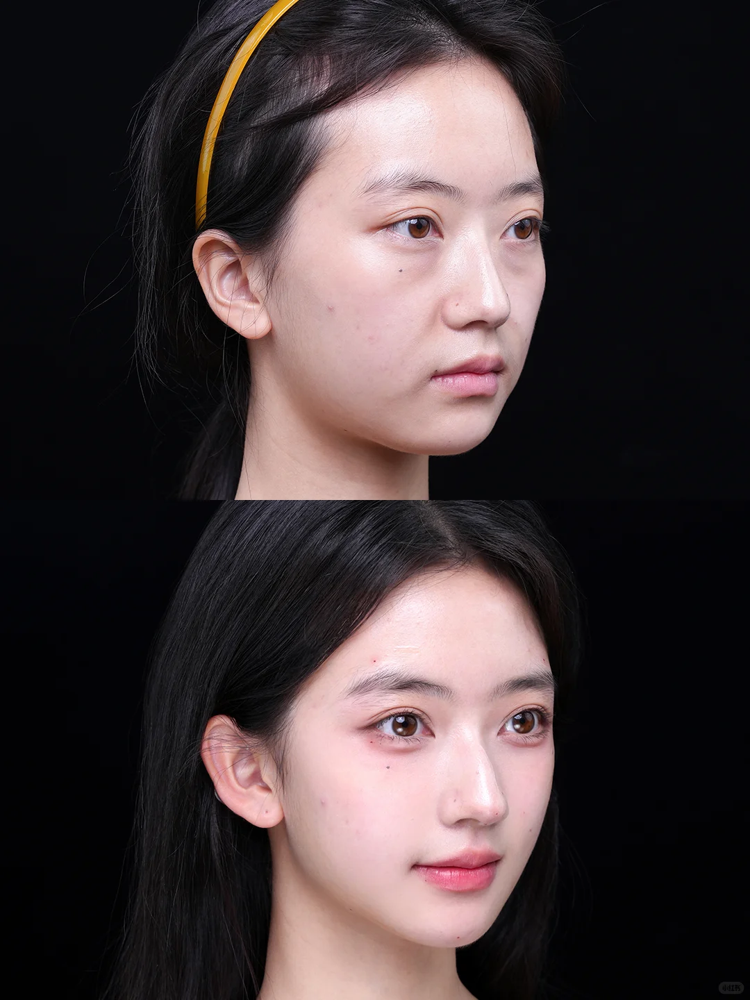 注射+轮廓，颜值已经到达下一个level