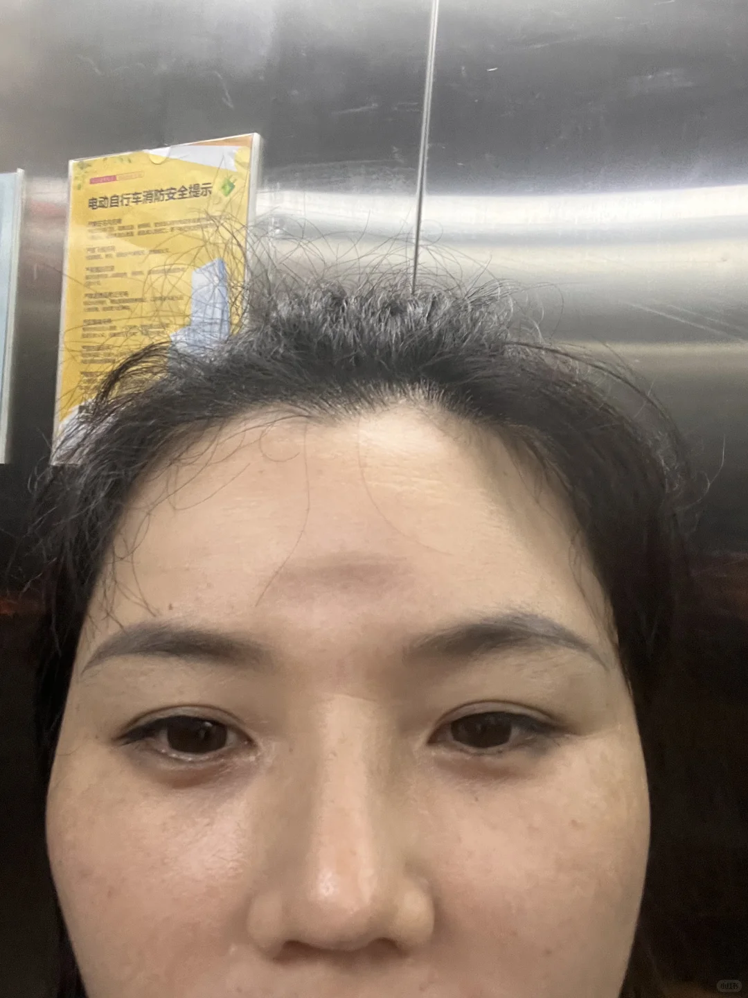 这就是玻尿酸的副作用