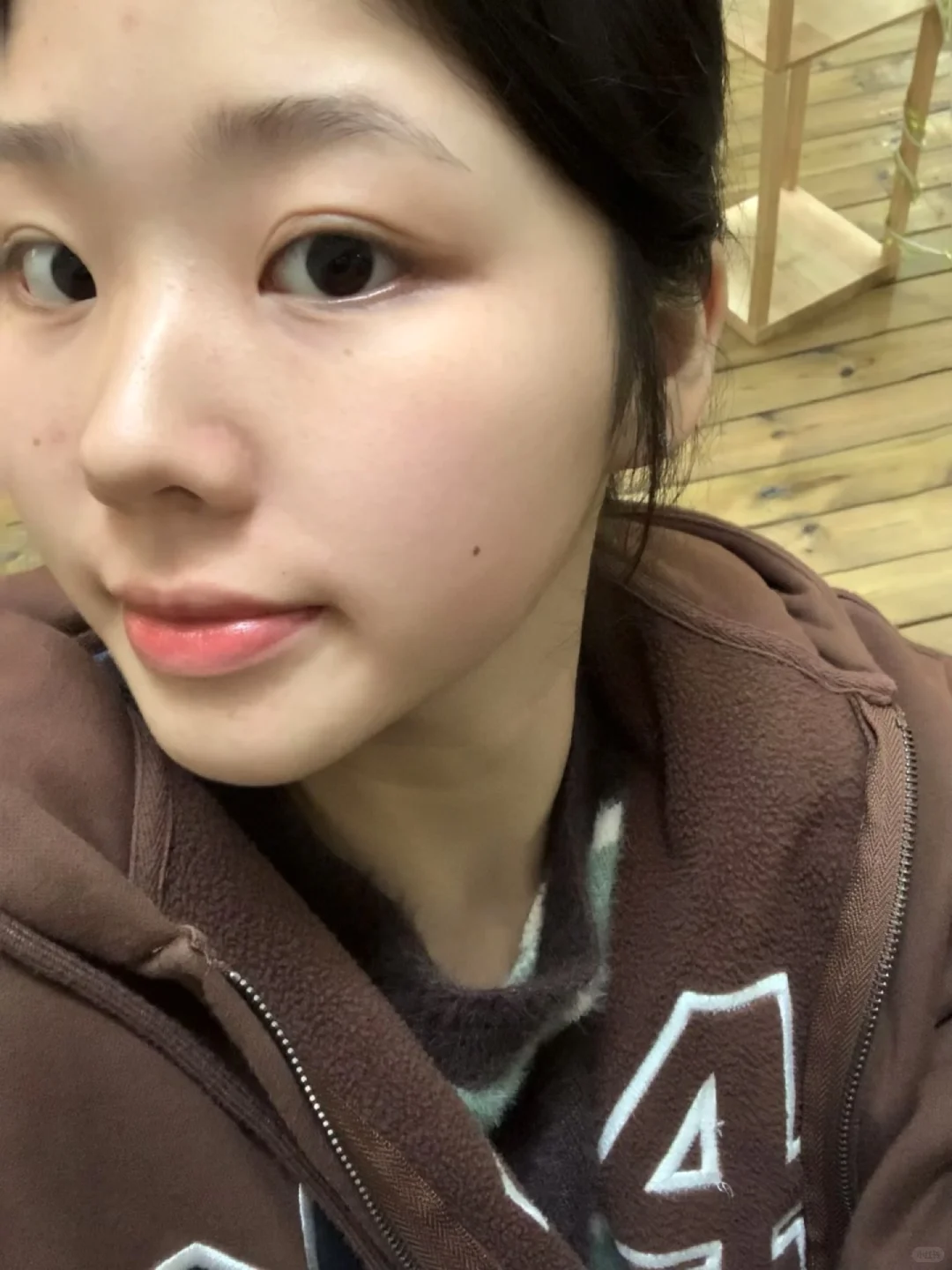 成都biu鼻基底两个月，咋还这么焦虑