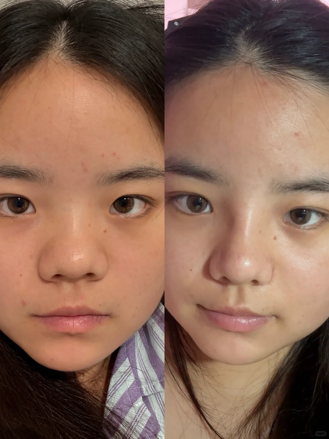 鼻整形第十七天对比！