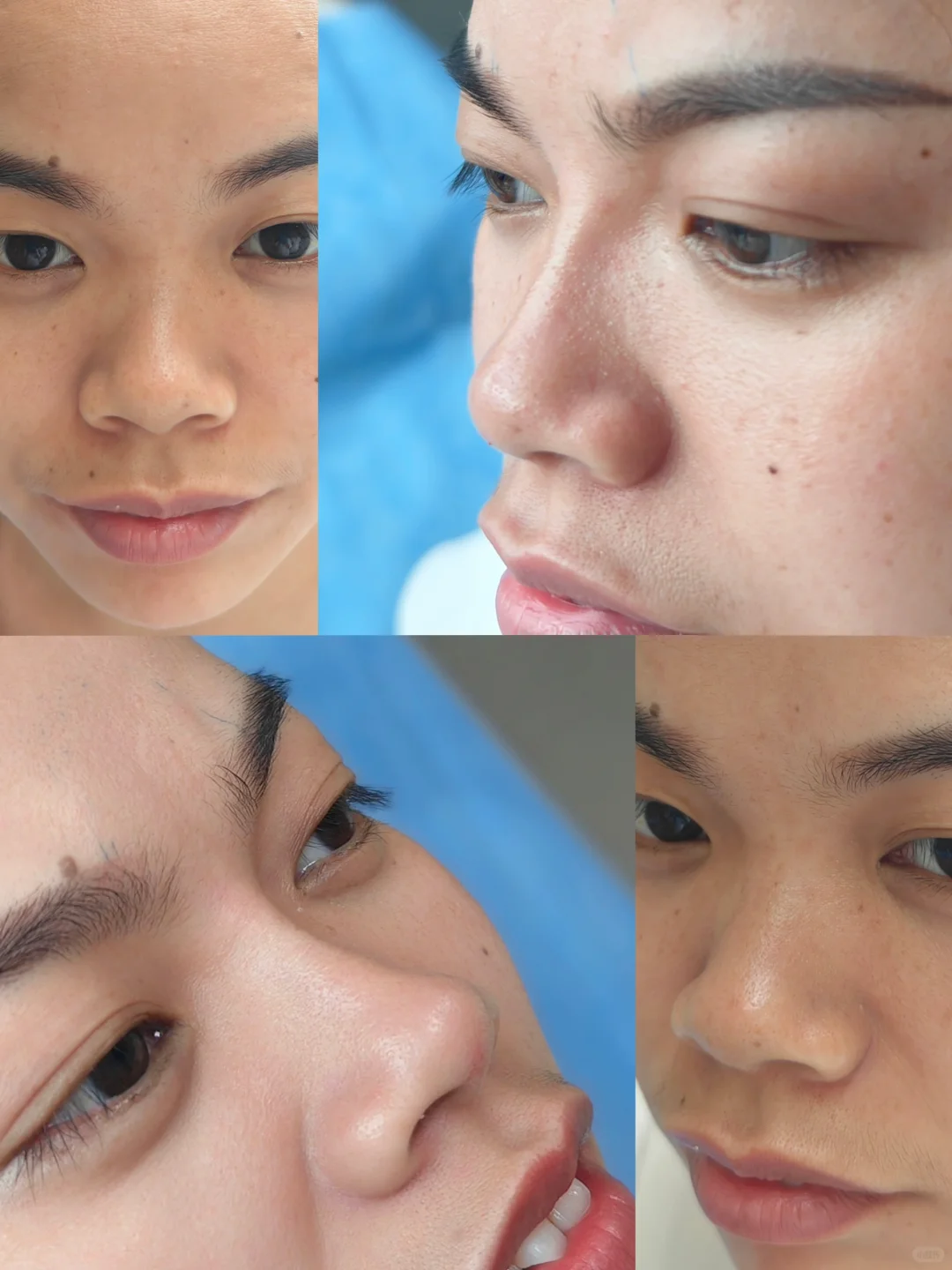 玻尿酸注射隆鼻