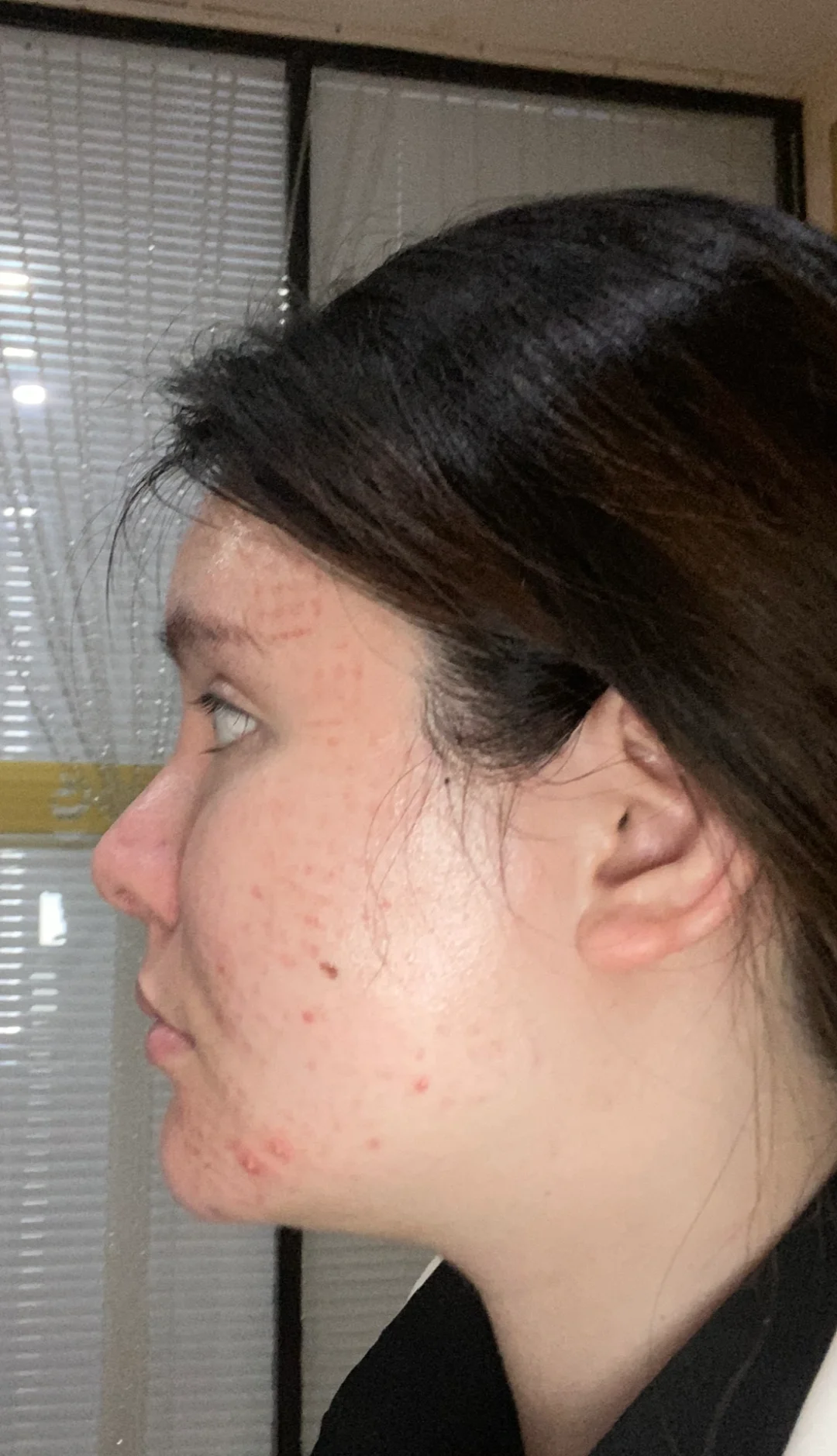 脂肪填充3次 把自己填成了一个球 上岸成功