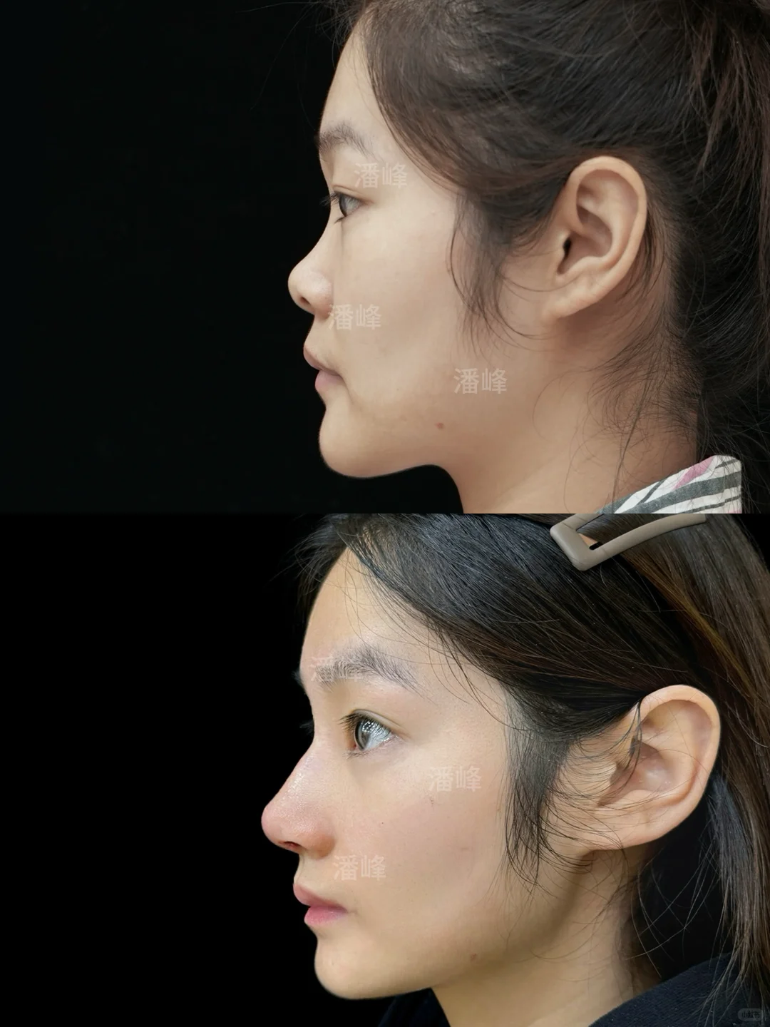 鼻修复👃🏻有时是一种审美变迁❤️