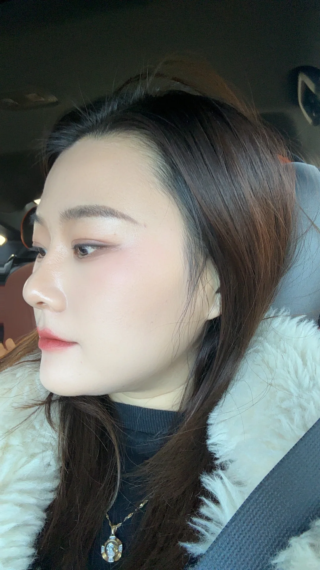 鼻假体取出100天啦