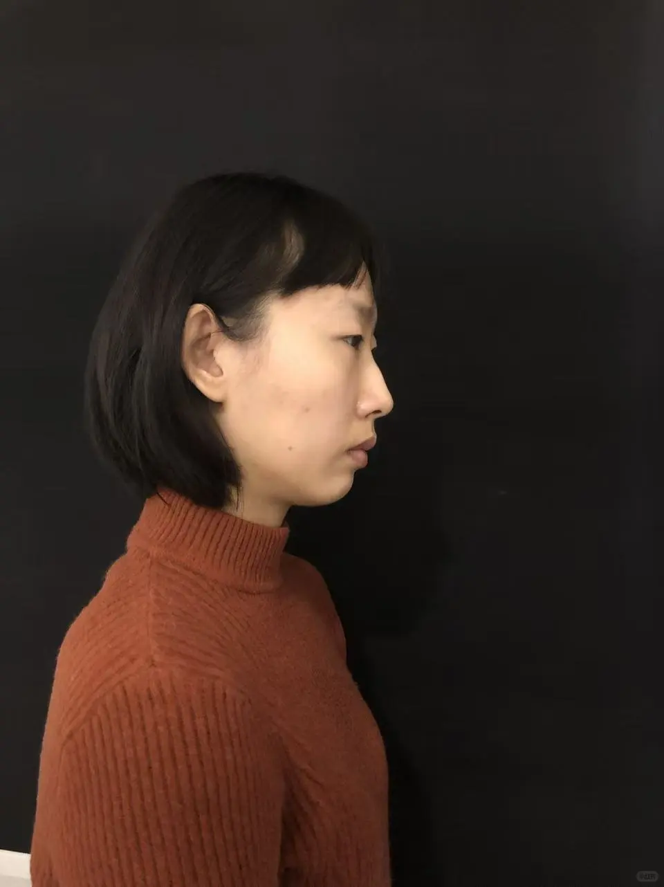 眼综合Day94+注射隆鼻/卧蚕Day50