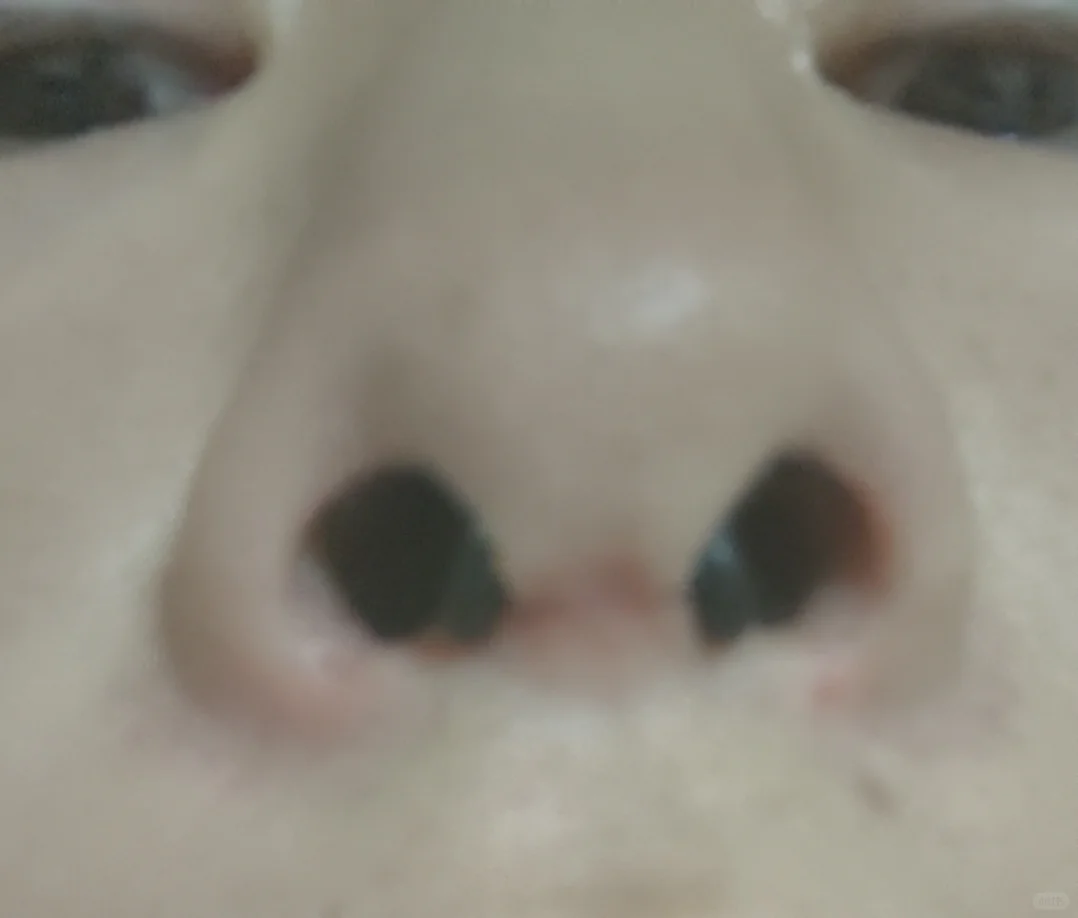 隆鼻整形鼻阀修复