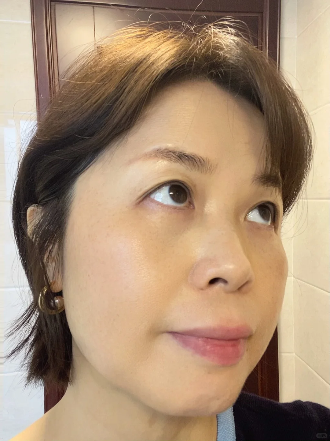 炎症排出来了！我真的没整容！