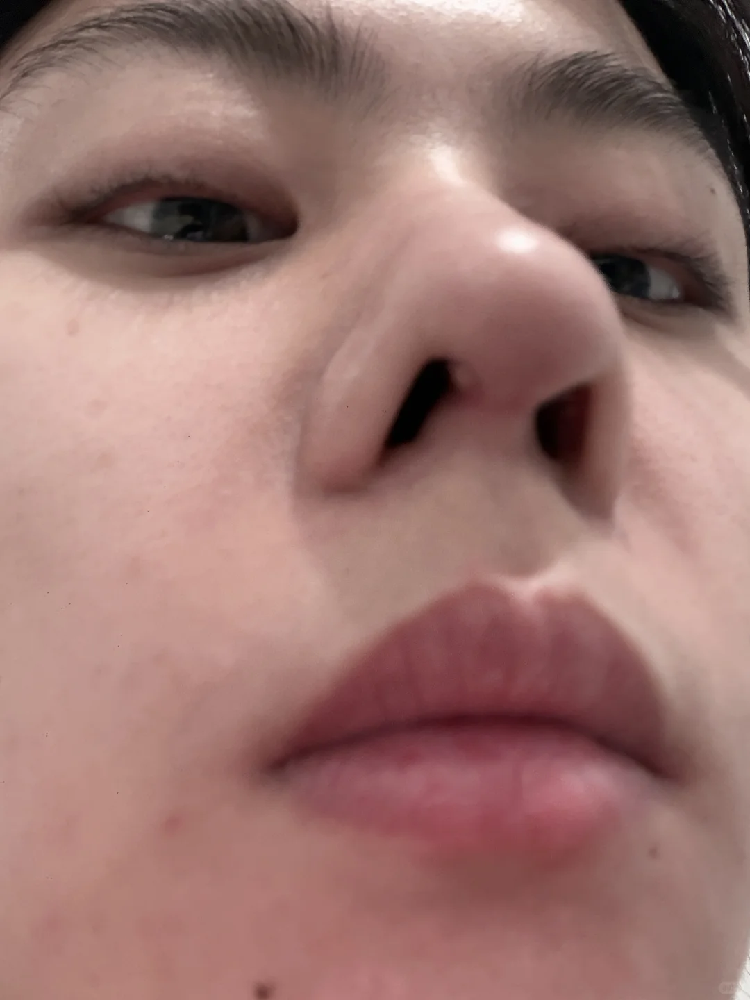 隆鼻后这是什么