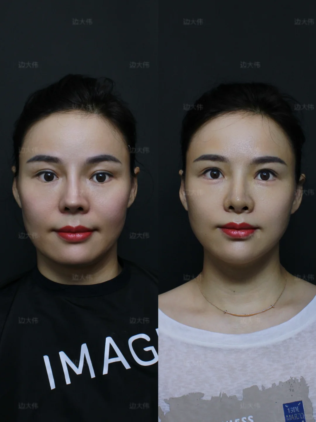 鼻修复｜原图直出📸通天鼻爆改自然妈生鼻