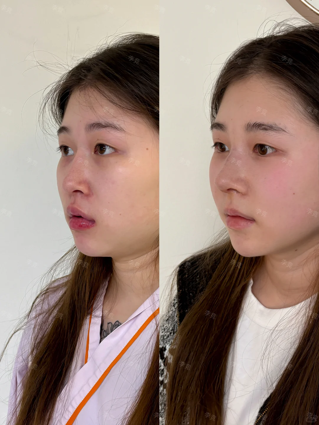 成都隆鼻圣手|纤铂塑造上镜骨感鼻