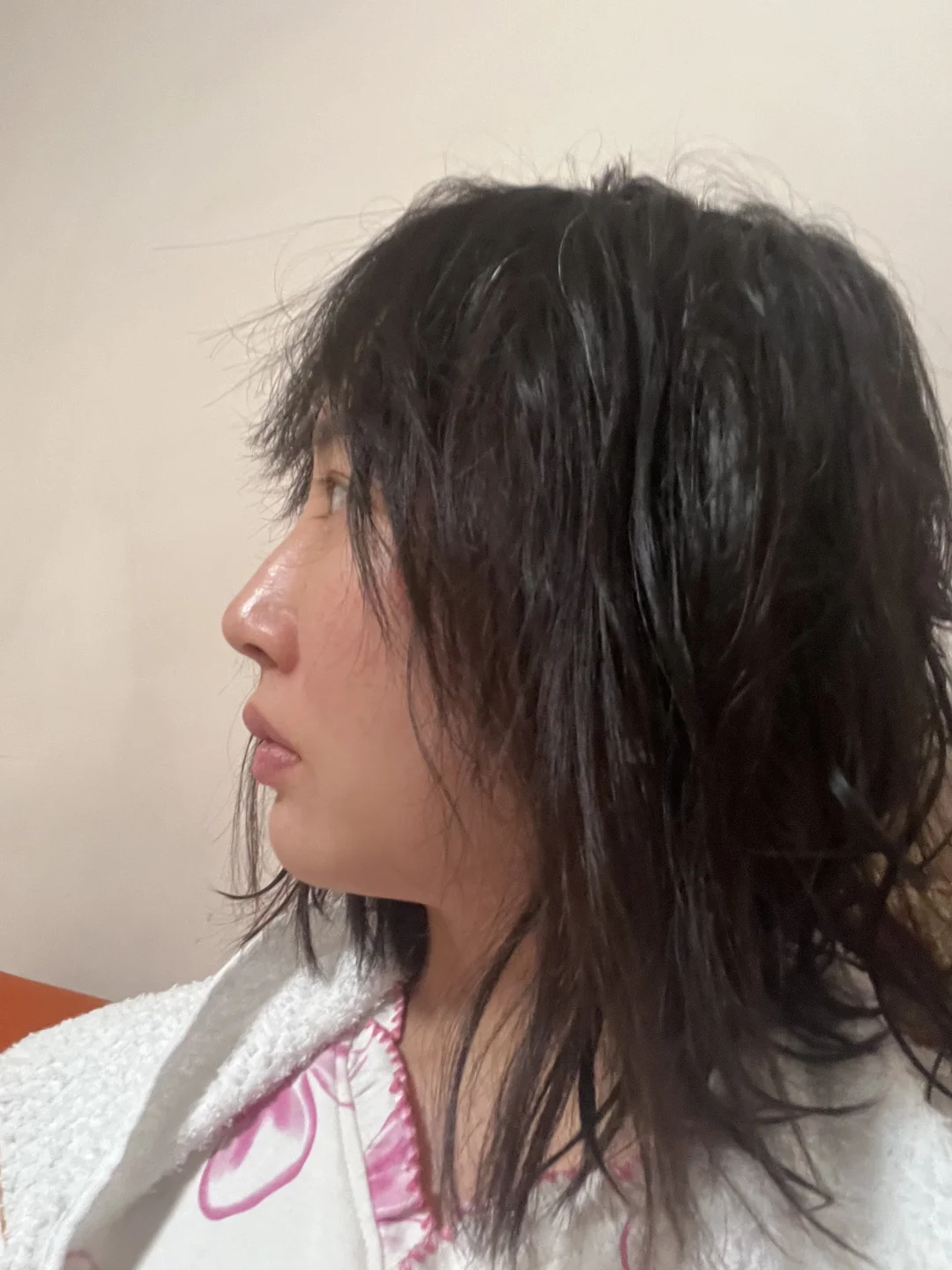 眼综合Day94+注射隆鼻/卧蚕Day50