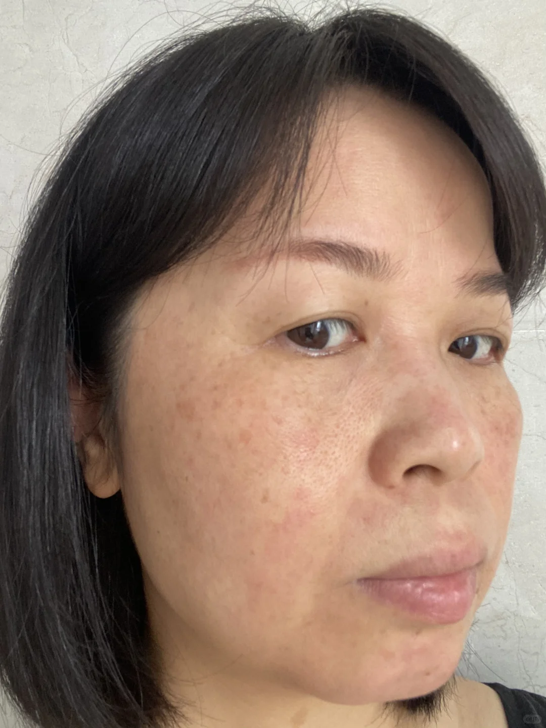 炎症排出来了！我真的没整容！