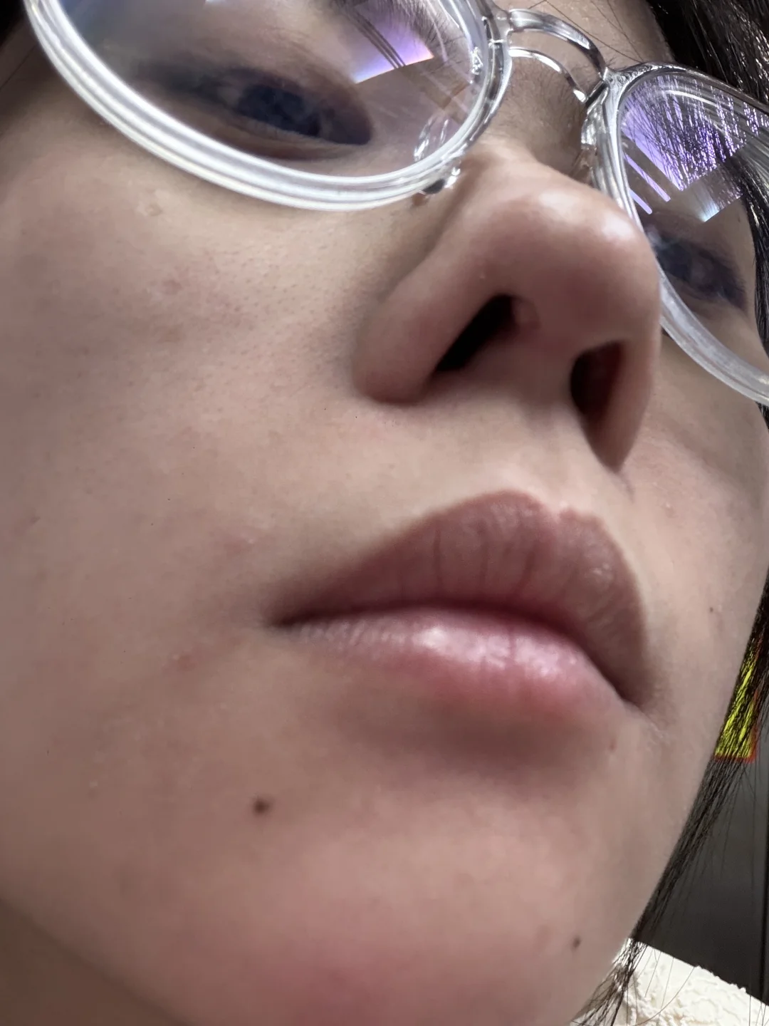 隆鼻后这是什么