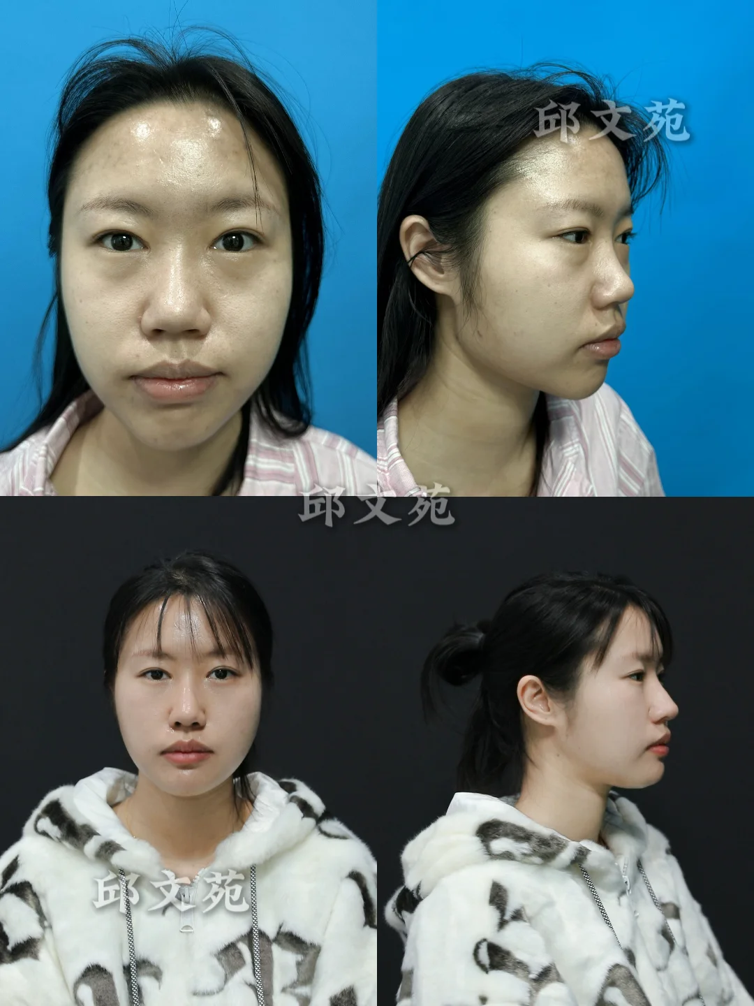 大鼻头修复丨妈生感直鼻微翘