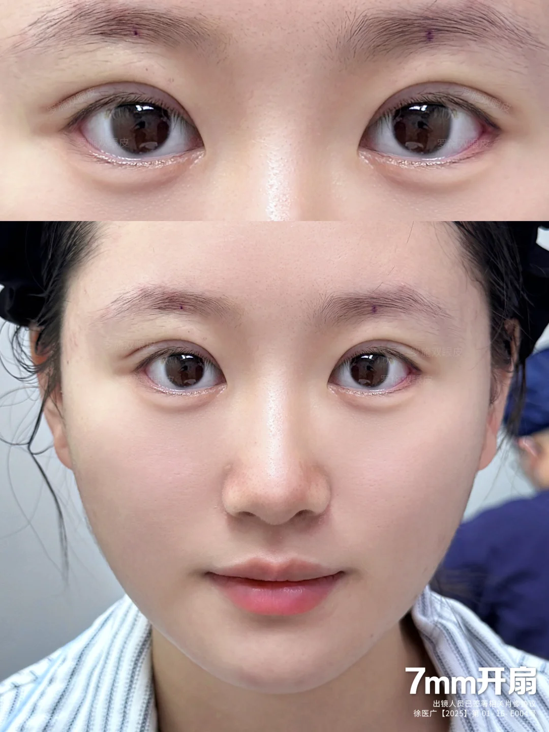 上海双眼皮｜7.5mm平扇➕幼态卧蚕～真的绝了😭