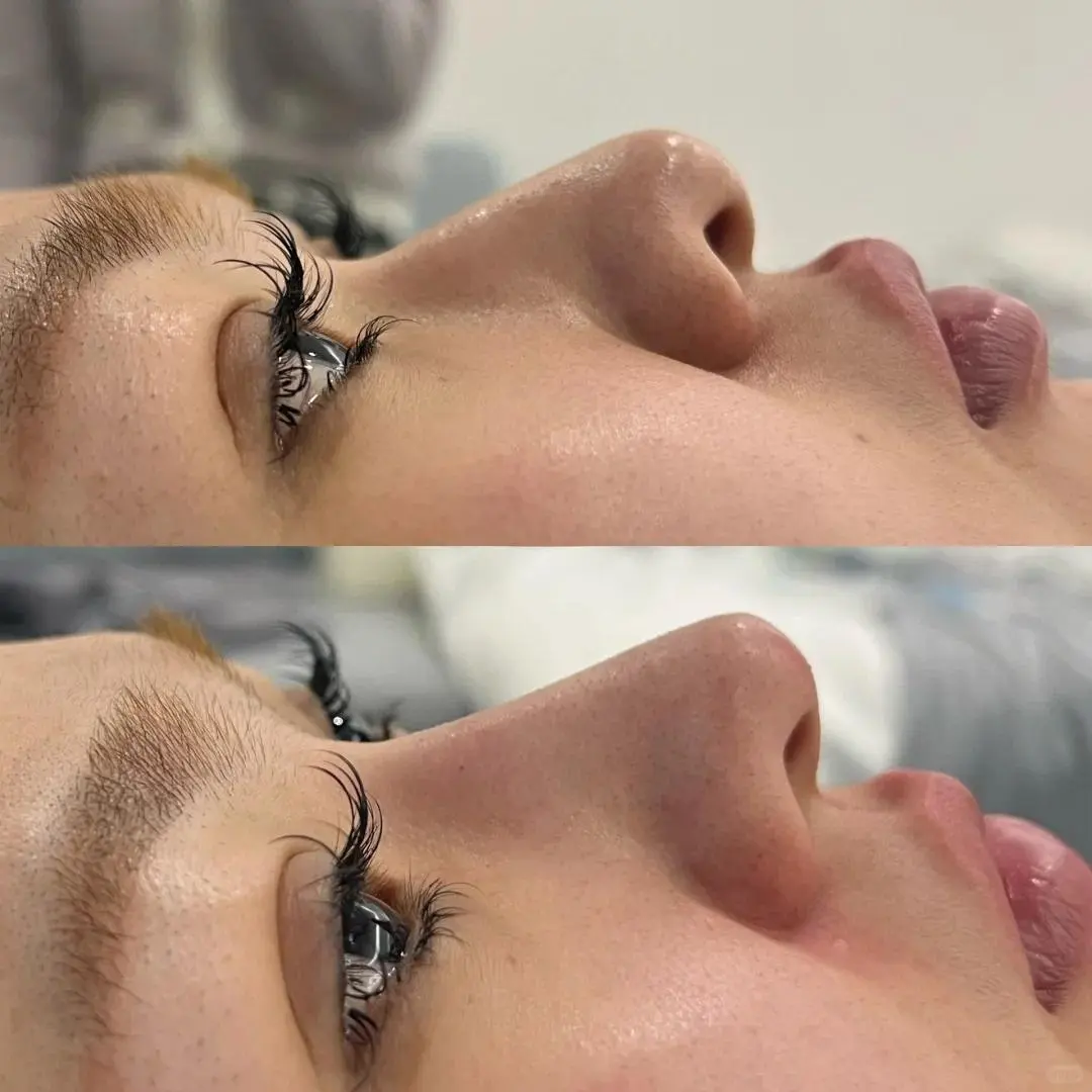 ⭕不刀刀注射妈生鼻，自然打造，精致鼻型