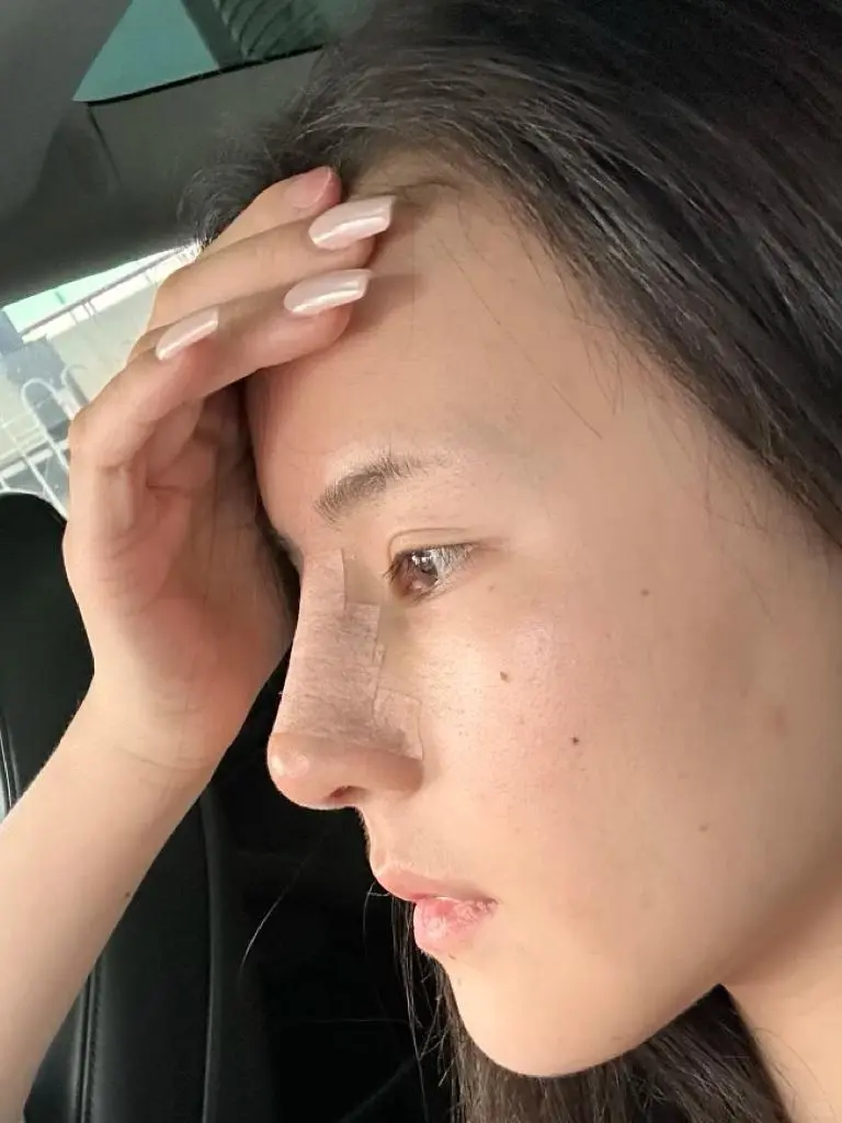 广州do了鼻子，这半个月真的太难了！