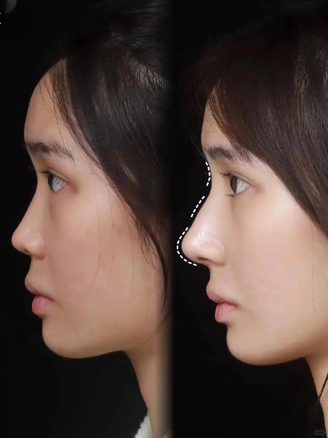 没有对比就没有伤害,妈生鼻V再生鼻